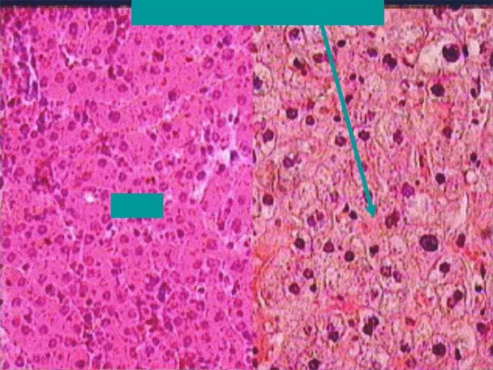 Токсическая дистрофия печени. Гидропическая дистрофия гепатоцитов гистология. Гидропическая дистрофия печени. Центролобулярные некрозы гистология. Гидропическая дистрофия печени микропрепарат.
