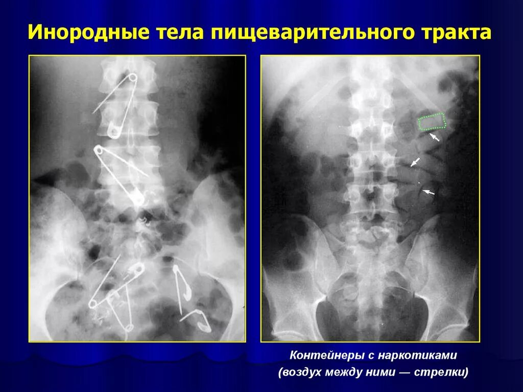 Инородные тела желудочно-кишечного тракта. Инородные тела желудочного тракта. Инородные тела пищеварительного тракта. Инородное тело в кишечнике. Инородные тела пищеварительного тракта.