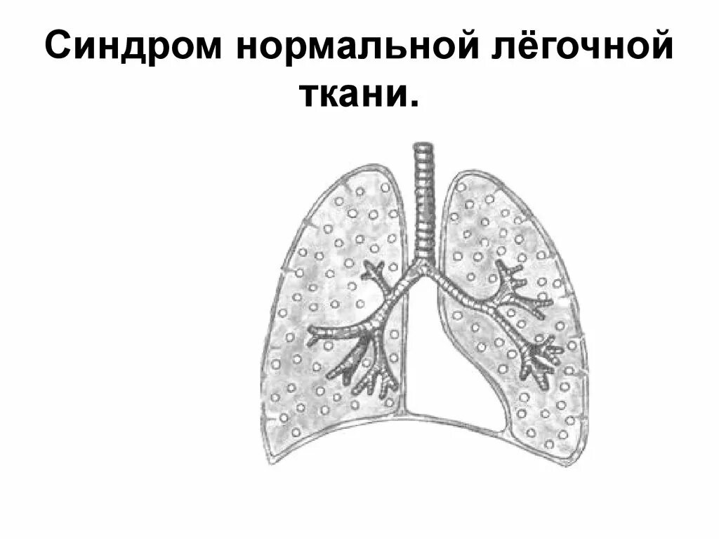 Типы уплотнения легочной ткани. Синдром нормальной легочной ткани. массивное уплотнение легочной ткани. мелкоочаговое уплотнение легочной ткани. синдром полости в легочной ткани схема.
