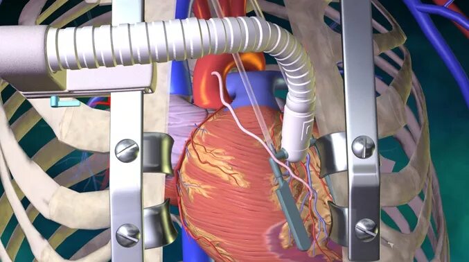 Шунтирование сосудов сердца. Операция на сердце шунтирование. Коронаро шунтирование.