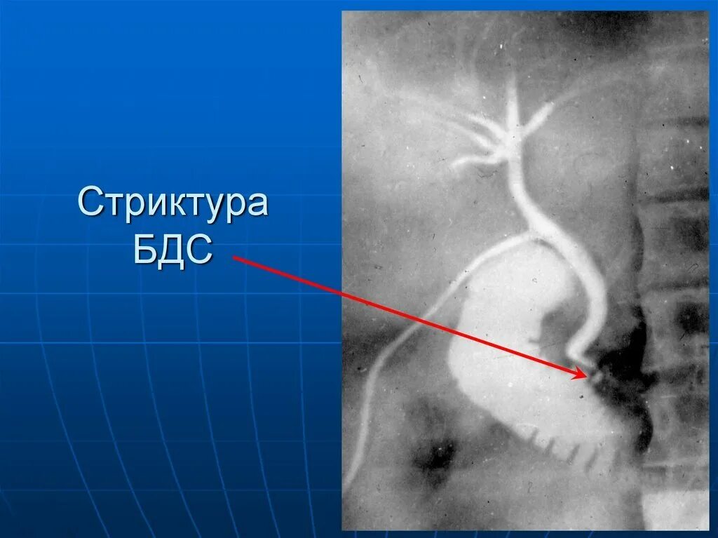 Стеноз кишечника что это. Стеноз дуоденального сосочка симптомы. Стеноз фатерова сосочка симптомы. Рубцовый стеноз фатерова сосочка. Опухоль дуоденального сосочка на кт.