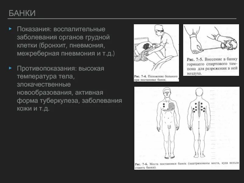 Места постановки банок. Схема постановки банок. Постановка банок показания. Постановка банок алгоритм. На сколько ставят банки на спину взрослым