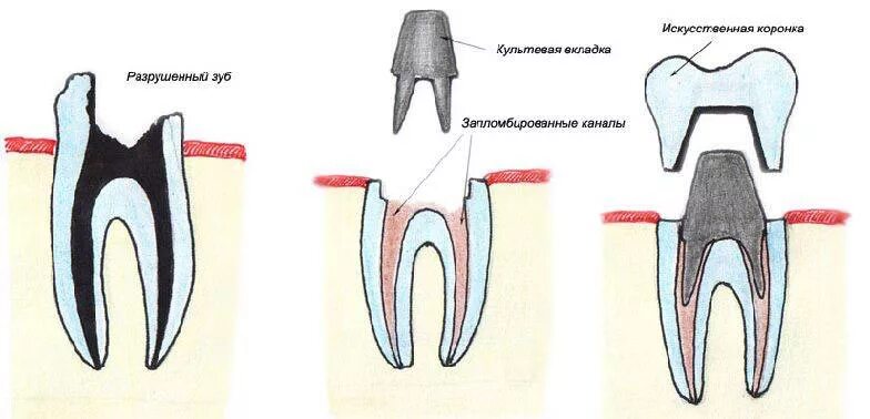 Почему ставят коронки. Культевая вкладка и коронка схема. Культовая вкладка и коронка. Культевая вкладка и коронка. Штифтовая культевая вкладка.
