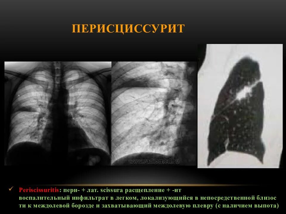 Заболевания левого легкого. Перисциссурит туберкулез рентген. Междолевой плеврит слева рентген. Инфильтративный туберкулез рентген перисциссурит. Перисциссурит инфильтрат.