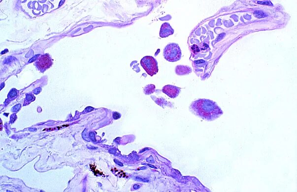 Альвеолярные макрофаги гистология. Альвеолярные макрофаги в мокроте. Альвеолярные клетки Макрофаг. Альвеолярные макрофаги мокрота микроскоп.