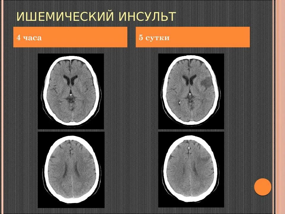 Очаги ишемии головного мозга. Стадии ишемического инсульта на кт. Ишемический инсульт на кт головного мозга. Ишемический и геморрагический инсульт на кт. Плотность ишемического инсульта на кт.