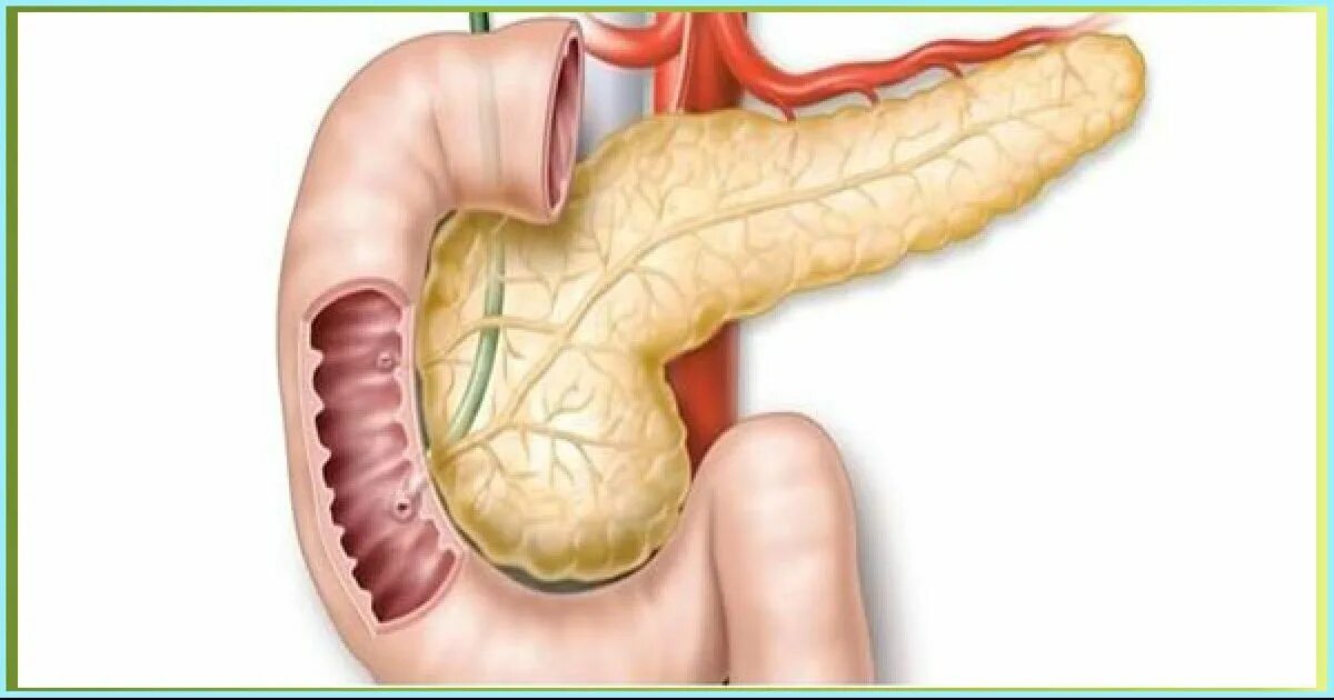Диабет пересадка поджелудочной железы. Агенезия поджелудочной железы. Аберрантная поджелудочная железа. Здоровая поджелудочная.