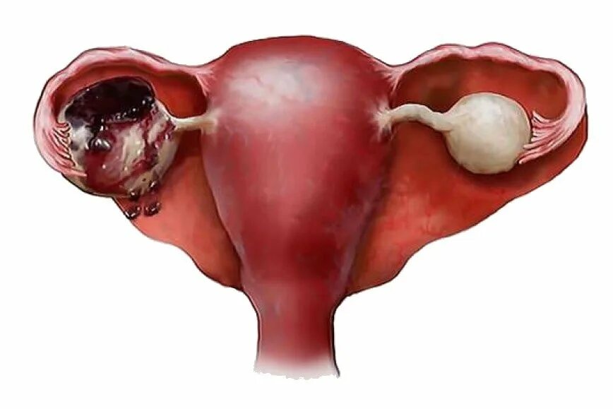 Кровь в полости матки. Апоплексия кисты яичника. Апоплексия, разрыв яичников. Апоплексия капсулы яичника.