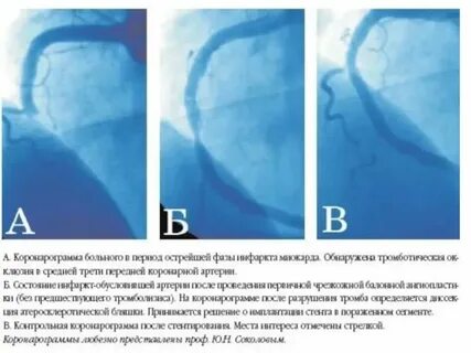 Операция на сердце после инфаркта