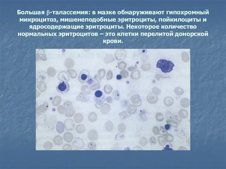 Талассемия мазок крови. Эритроциты в мазке крови. Эритроциты при талассемии. Картина крови при талассемии. Определение количественного и качественного состава крови