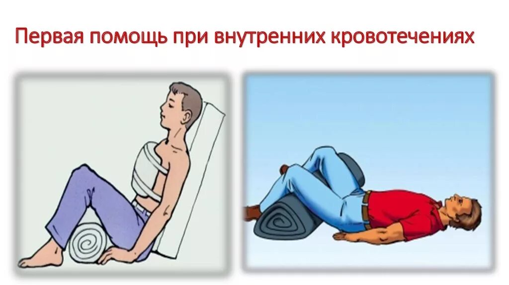 Внутреннее кровотечение положение пострадавшего. Внутреннее кровотечение оказание доврачебной помощи. внутреннее кровотечение пмп. первая помощь при кровотечении внутренне. первая помощь при внутреннем кровоизлиянии.