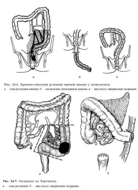 Передняя резекция прямой кишки схема. Анастомоз сигмовидной кишки. Субтотальная резекция толстой кишки. Операции через прямую кишку