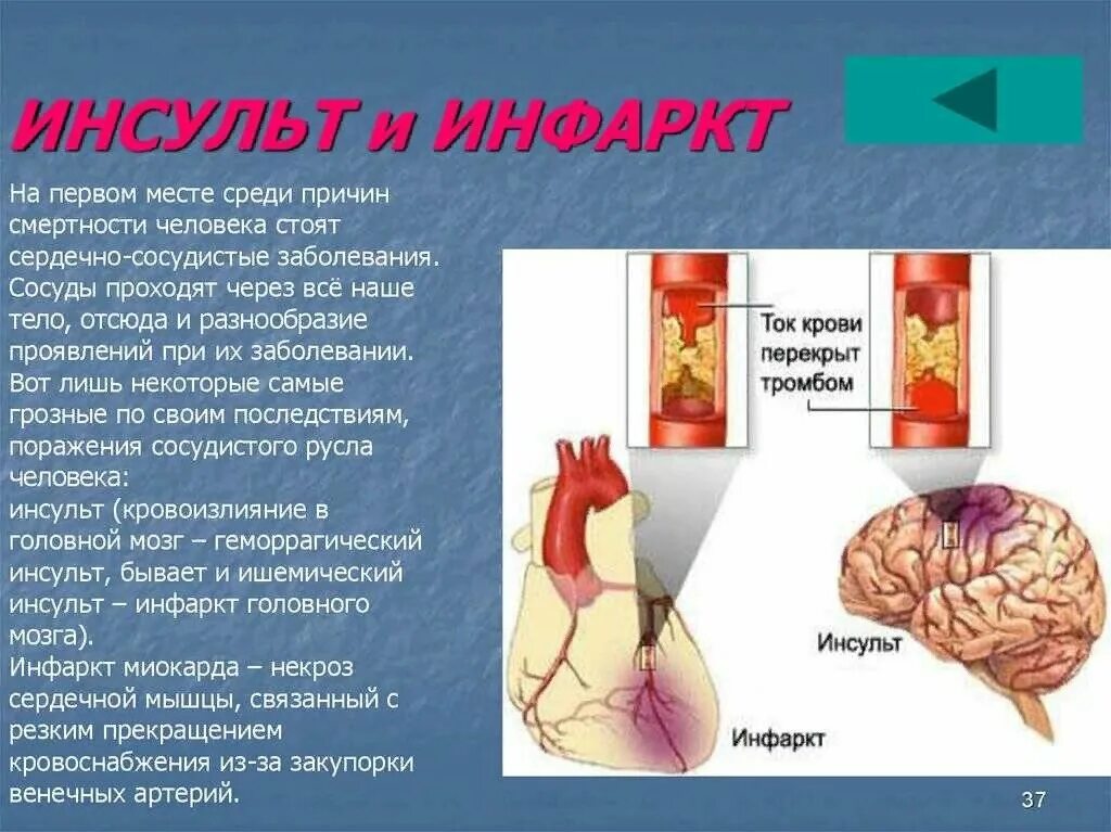 Чем отличается инфаркт от инсульта простыми