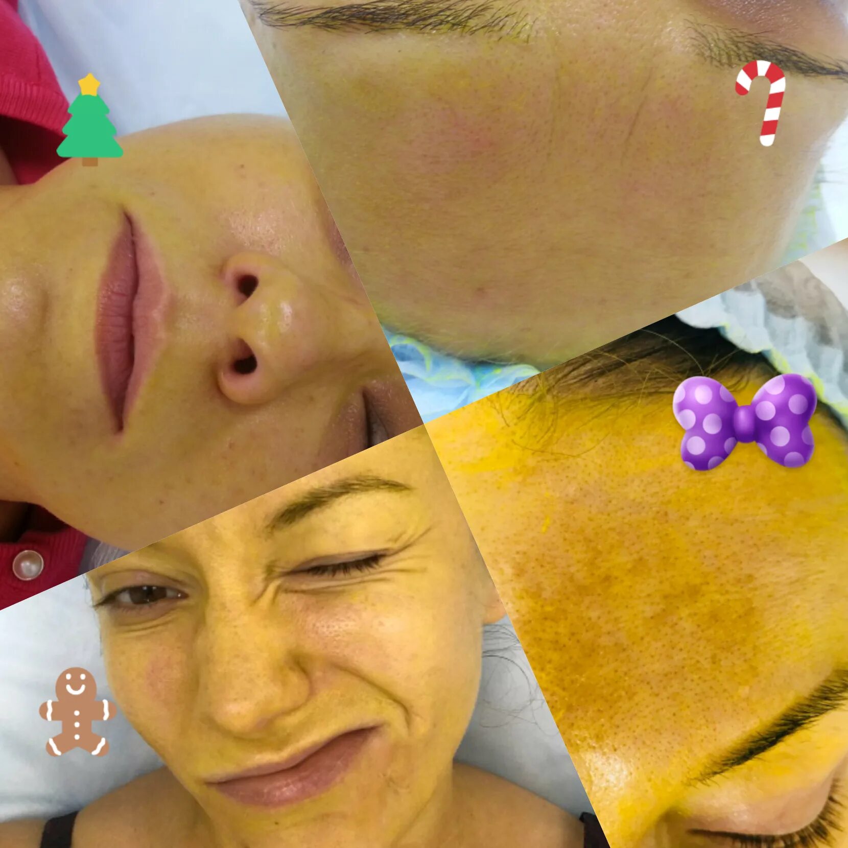 жёлтый ретиноевый пилинг для лица. жёлтый пилинг для лица ретиноевый до и после. пилинг желтый ретиноловый. срединный пилинг тса 35. пилинг желтый ретиноловый.