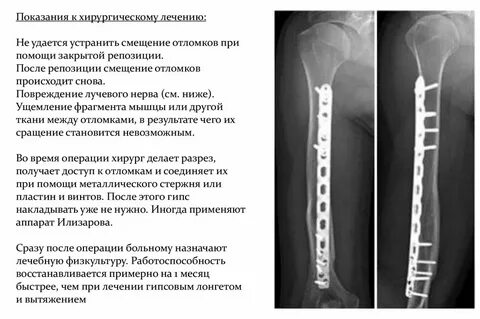 Репозиция костей