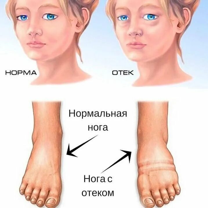 Отеки после 30 лет. Отечность лица и конечностей.