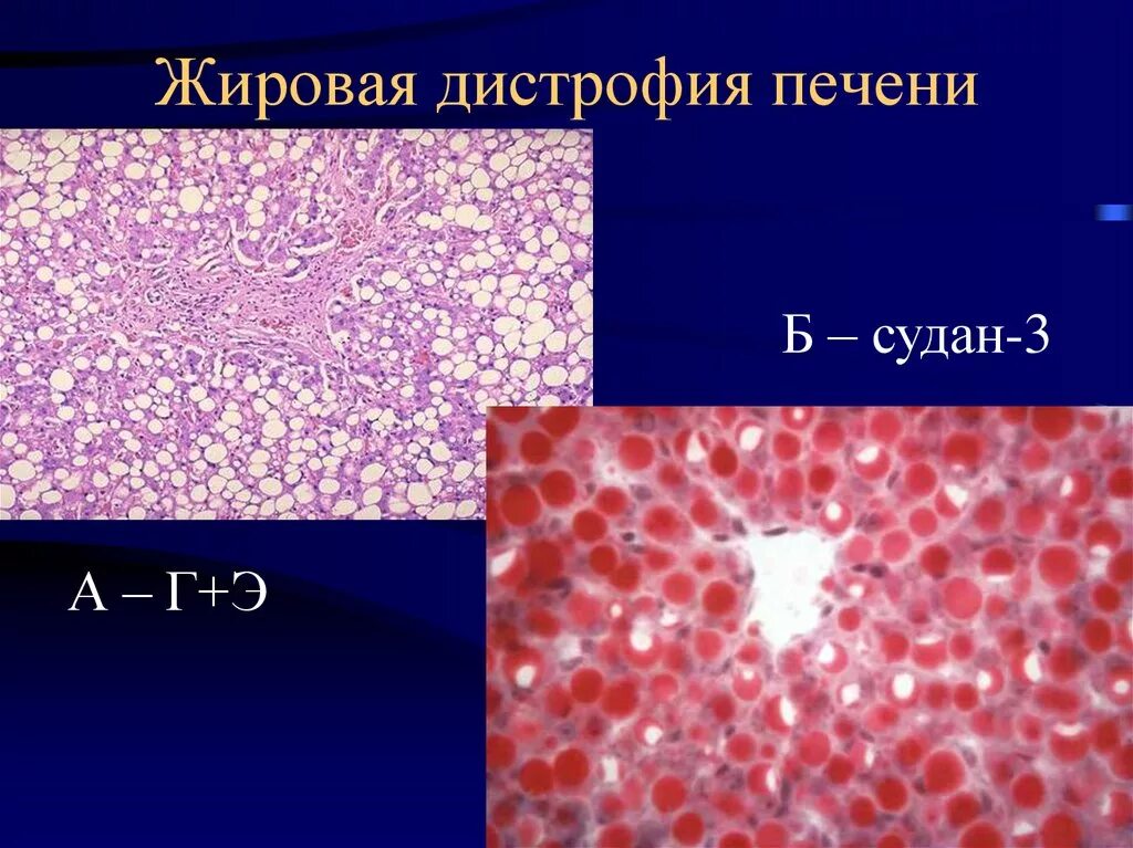 Дистрофия печени причины. Жировая дистрофия Судан 3. Жировая дистрофия печени патанатомия Судан 3. Мезенхиальная дистрофии печени. Мезенхимальная дистрофия печени.