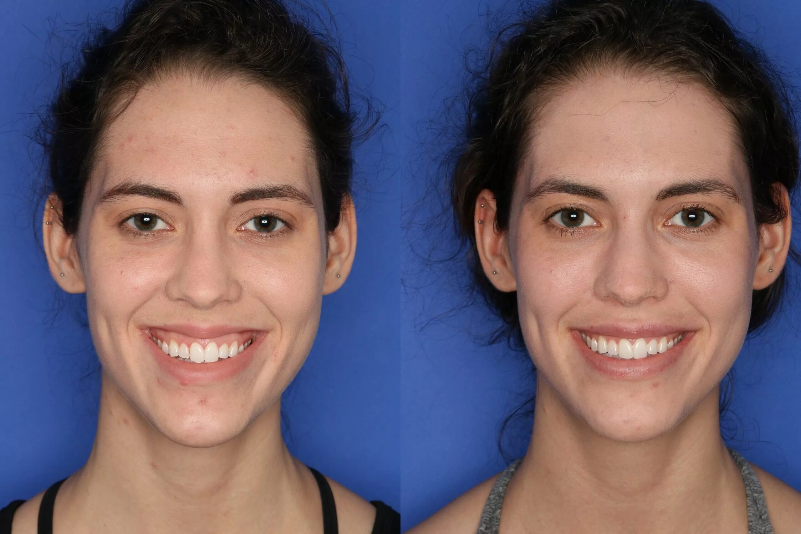 десневая улыбка коррекция ботоксом. хейлопластика десневая улыбка. ботулотоксин десневая улыбка. ботулотоксин десневая улыбка. исправление десневой улыбки.