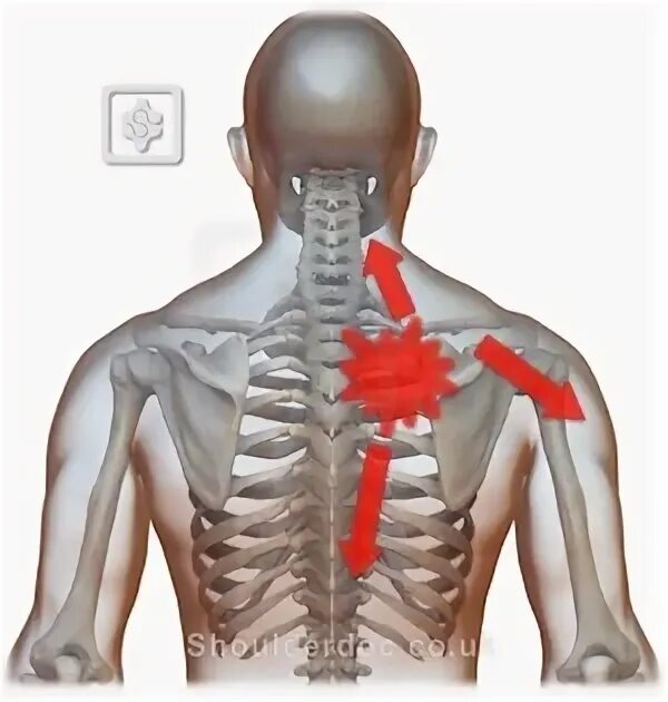 Back between. Pain between the scapula. Interscapular. Trigger point serratus anterior Joe Muscolino. Periscapular area Trigger.