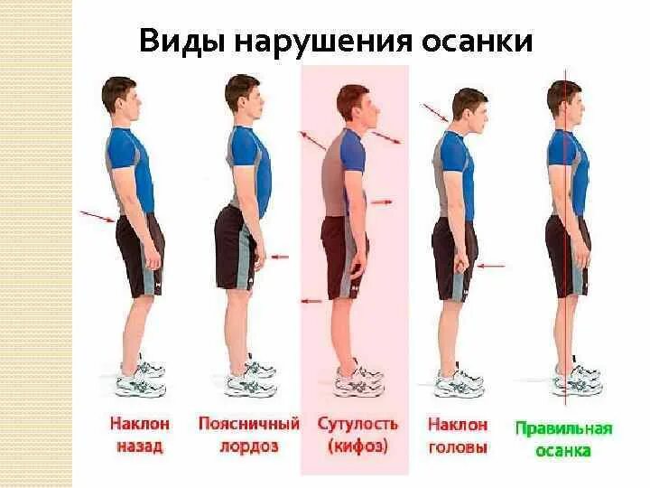 Круглая спина упражнения. Типы осанки. Нарушение осанки. Изображение типов осанки человека. Типы нарушений осанки сутулость.