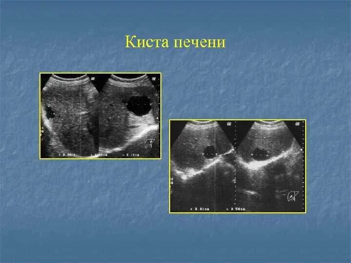 Киста на печени причины чем опасна. Тонкостенная киста печени. Киста печени двухкамерная.