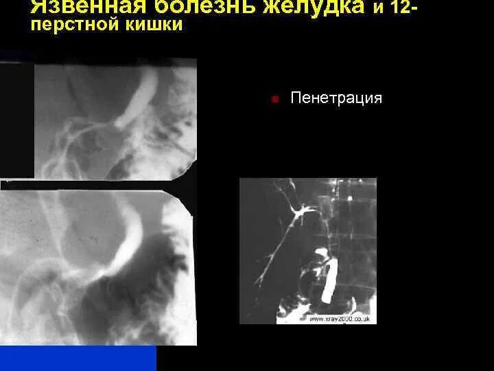 Пенетрация язвы желудка рентген. Пенетрирующая язва желудка кт. Пенетрирующая язва желудка рентген. Пенетрация язвы желудка клиника. Язва кт