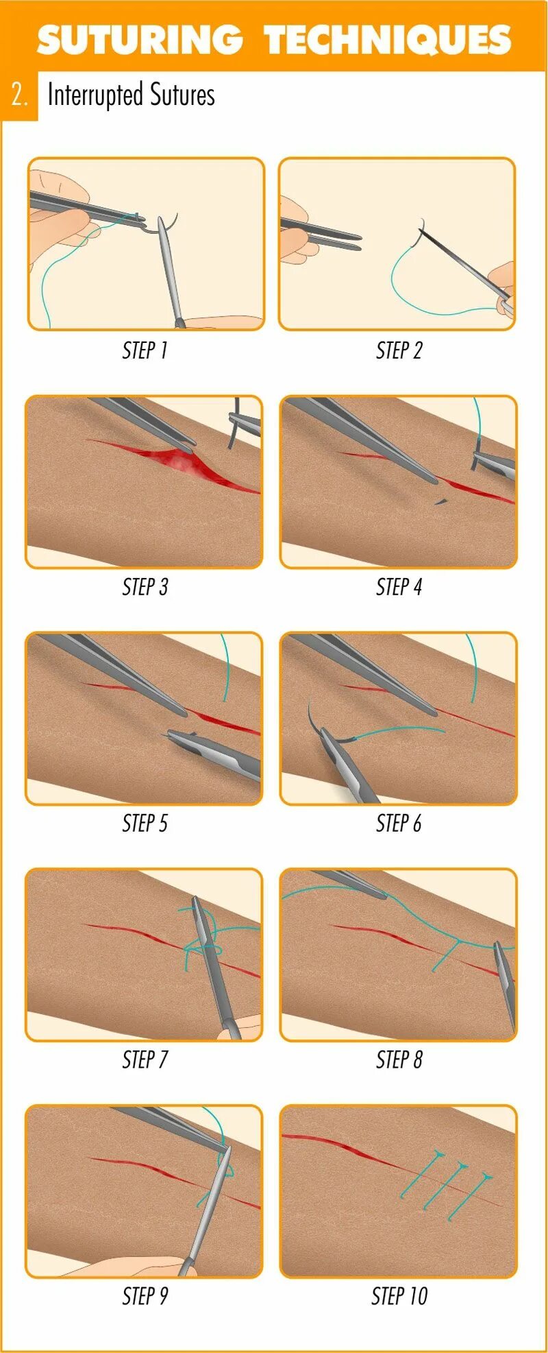 Surgical Sutures The survival encyclopedia Surgical suture, Medical knowledge, S