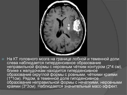 Размер очагов в головном мозге