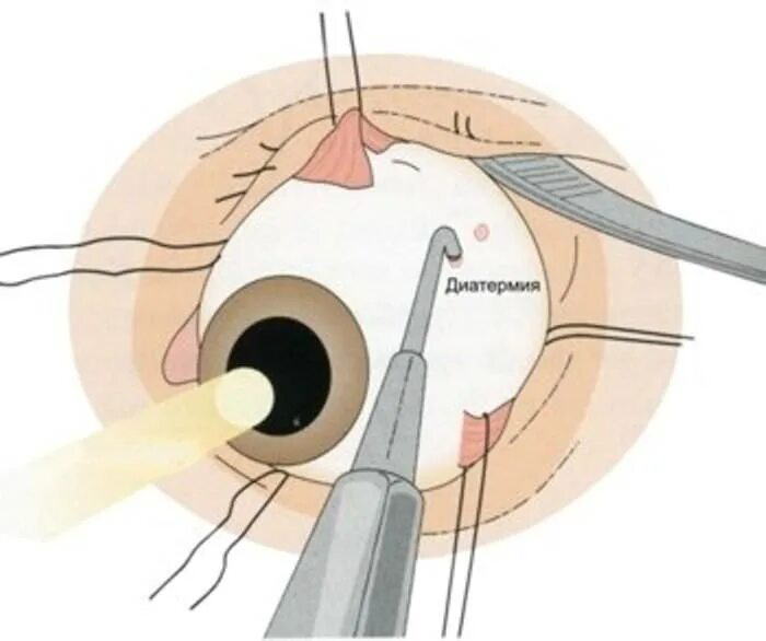 Разрыв сетчатки лазерная коагуляция. Склеральное пломбирование сетчатки. Лазерокоагуляция сетчатки глаза. Лазеркоагуляция разрывов сетчатки глаза.