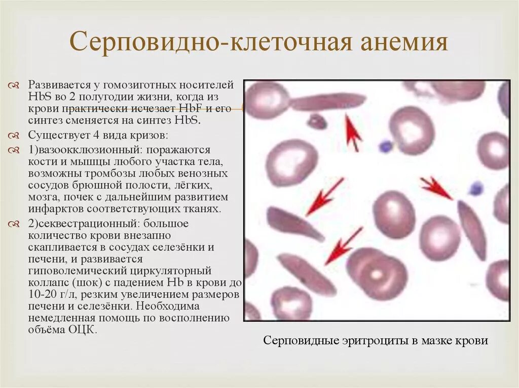 Серповидно клеточная анемия признаки. Серповидноклеточная анемия биохимический метод. Серповидноклеточная анемия картина крови. Серповидноклеточная анемия ретикулоциты. Серповидноклеточный анемия картинакр ви.