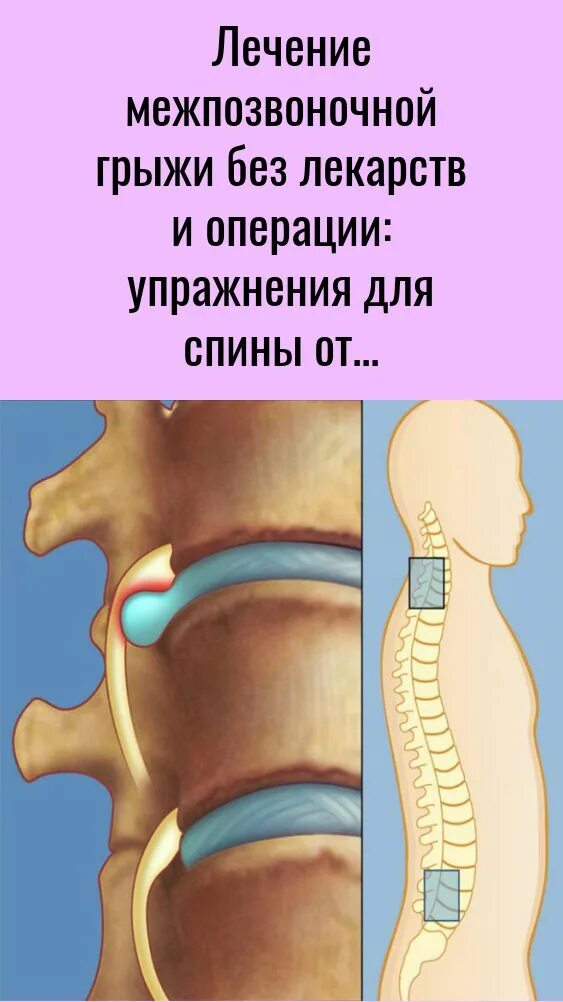 Грыжа позвоночника. Межпозвонковые грыжи. Спинная грыжа. Грыжа позвоночника без операции.