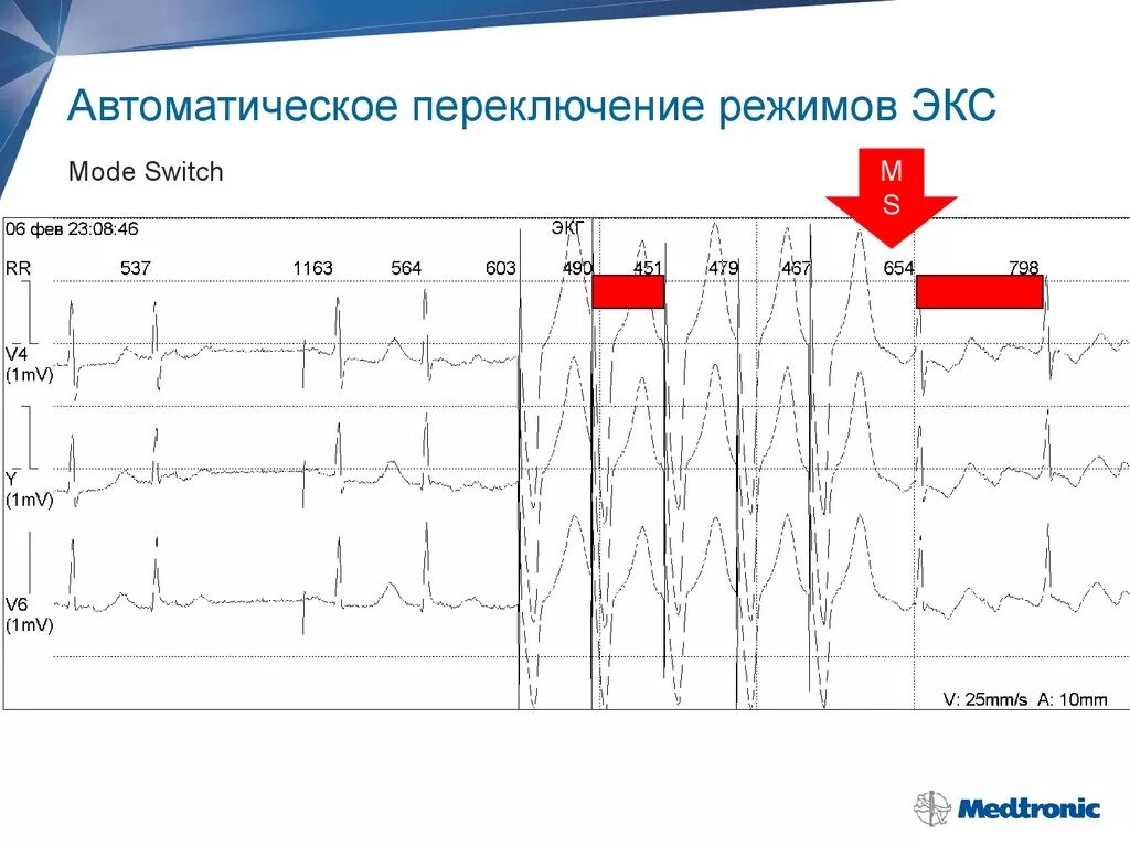 Switch Mode экс. Режимы работы экс. График коммутации. Режимы стимуляции экс.