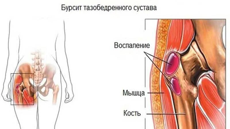 Сильные боли в области бедра. Вертельный бурсит тазобедренного. Боль в обл тазобедренного сустава. Бурсит тазобедренного сустава боль. Бурсит трохантерит тазобедренного сустава.