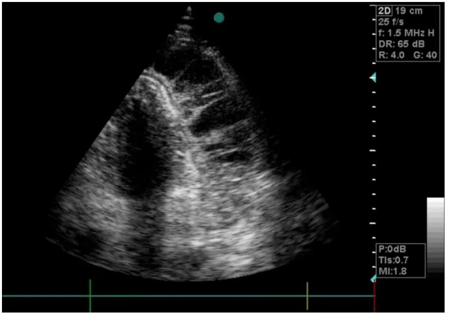 Скопление воздуха и крови в перикарде. Гидроперикард на ЭХОКГ. Эхокардиография.тампонада сердца.. Выпотной перикардит ЭХОКГ. Тампонада сердца на ЭХОКГ.