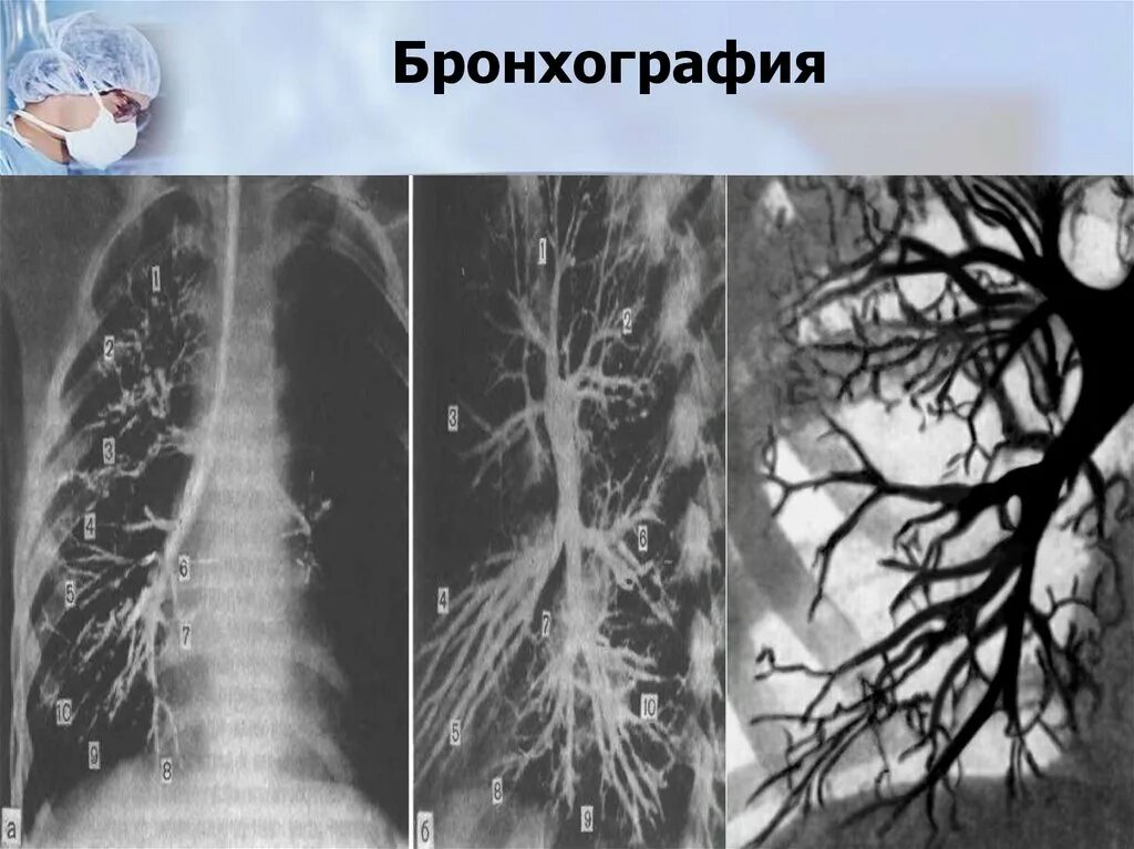 Бронхография при бронхите. Бронхоэктатическая болезнь бронхография. Бронхография дыхательная системы. Мешотчатые бронхоэктазы на бронхографии. Контрастная бронхография.