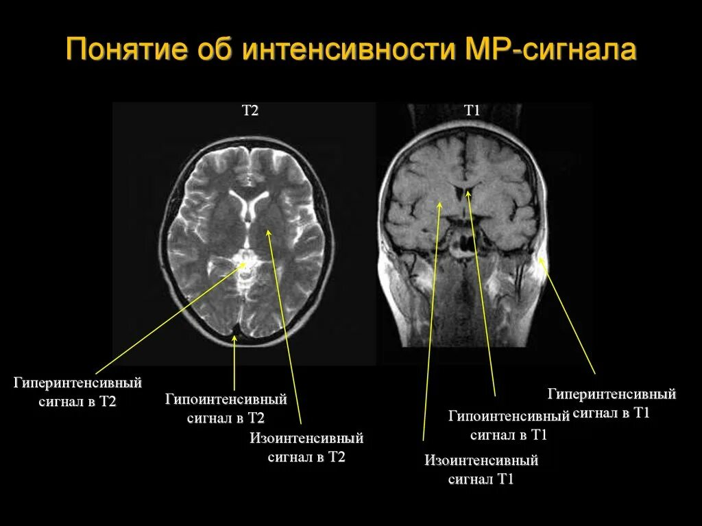 Усиленный в базальных отделах. Мрт гипоинтенсивный сигнал т2. Сигналы мрт т1 и т2. Мрт головного мозга т2. Т2 взвешенное изображение мрт.