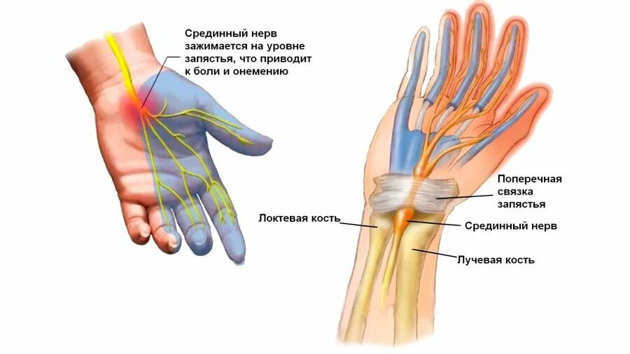 Поражение срединного нерва руки. Руки нервно. Руки нервно. Дрожание пальцев рук. Руки нервно.
