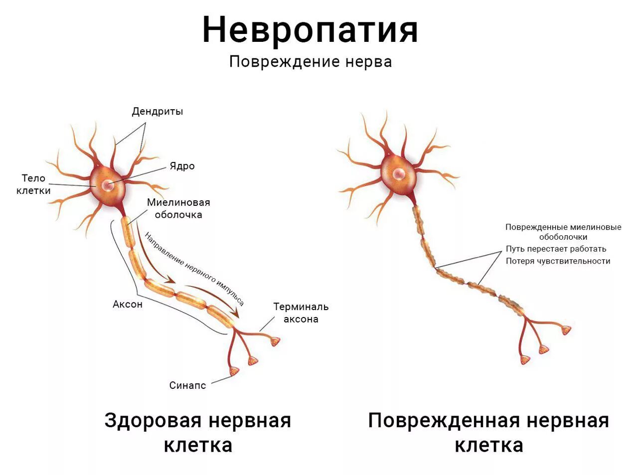 Сколько живет нерв. Нейроны головного мозга строение. Нервная клетка. Нервные клетки восстанавливаются. Поврежденный Нейрон.