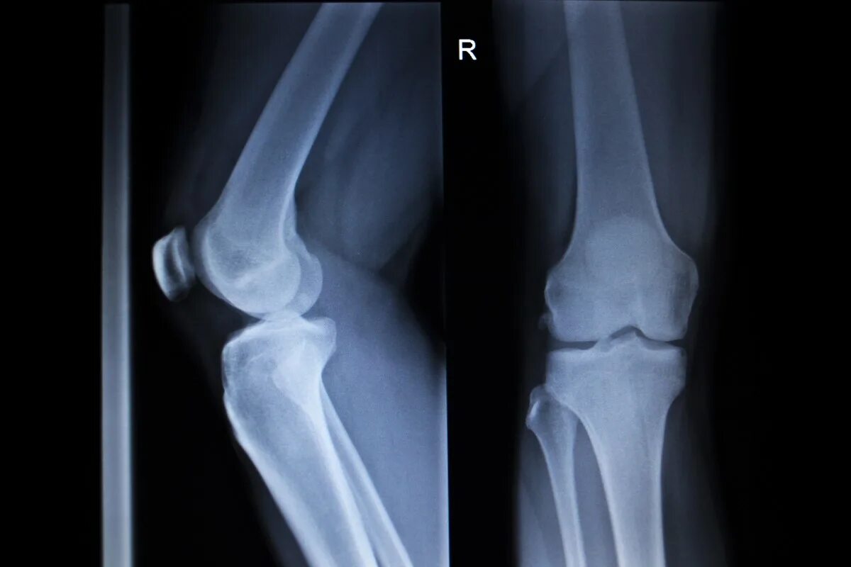 мениск коленного сустава рентген. разрыв мениска снимок рентген. тендиноз коленного сустава рентген. разрыв мениска рентген. перелом малоберцовой кости.