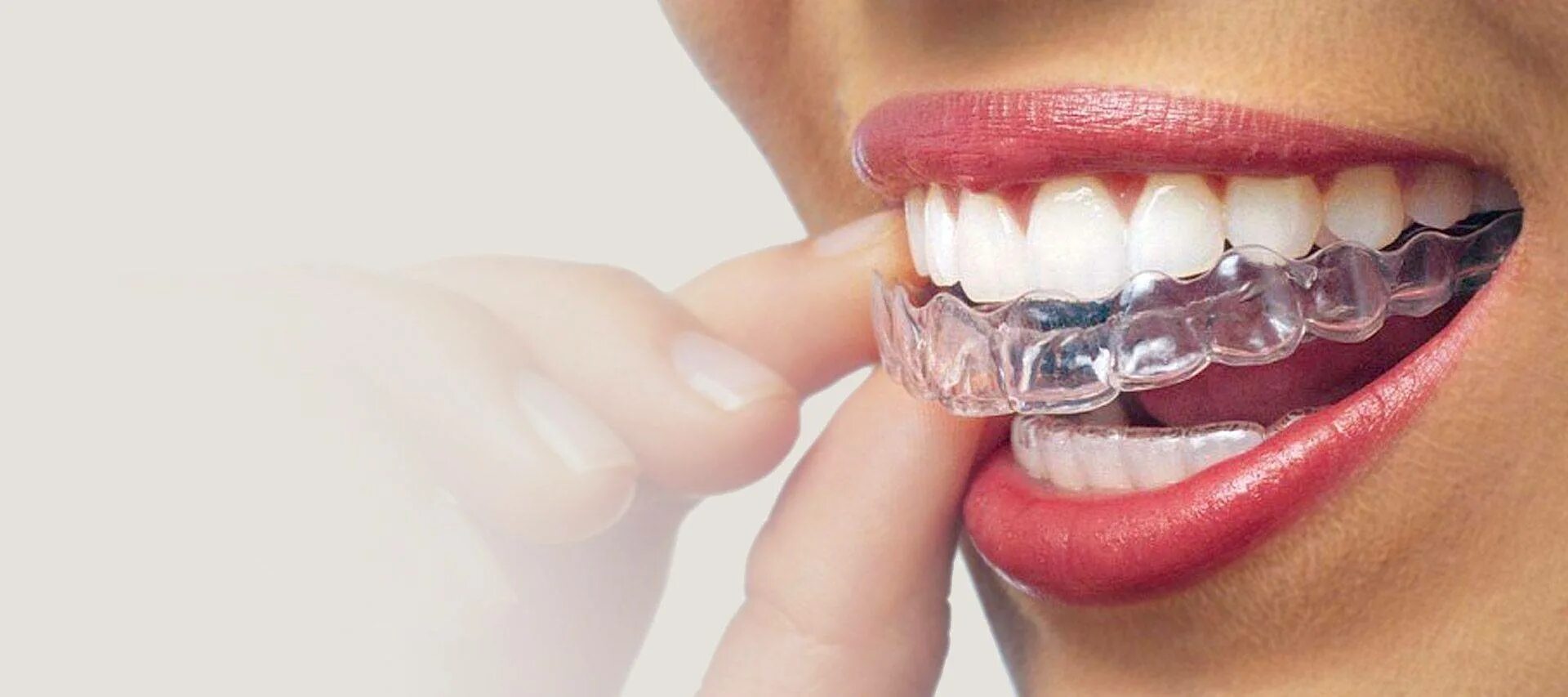 Как называется капа. Ортопедические капы. Капа ортодонтическая силиконовая. Съемный ретейнер каппа. Капа ортодонтическая силиконовая.