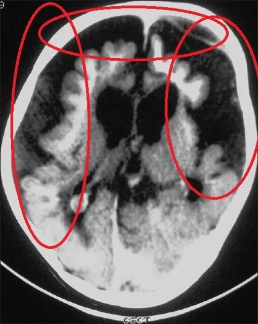 Церебро-церебеллярная атрофия. Корковая атрофия головного мозга кт. Диффузная церебральная