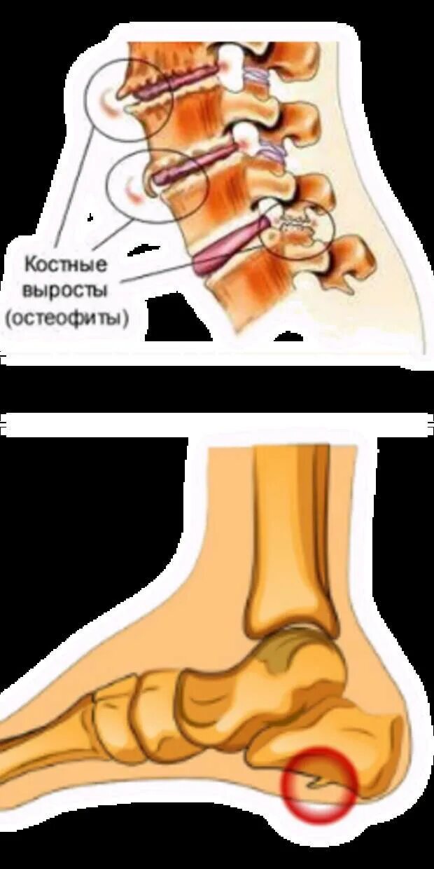 Шпоры причина появления. Плантарный фасциит пяточной кости. Дорзальная пяточная шпора. Подошвенная пяточная шпора.