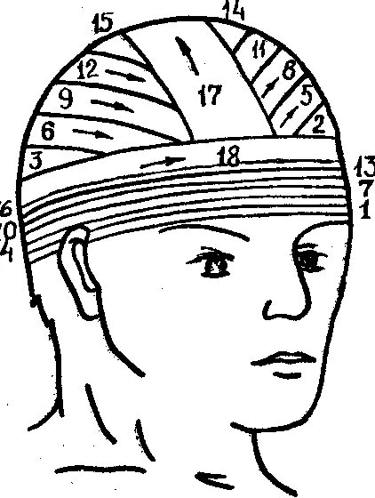 Повязка гиппократа техника наложения. Чепец и шапочка Гиппократа. Десмургия шапочка Гиппократа. Бинтование головы шапочка Гиппократа. Шапочка Гиппократа повязка техника наложения.