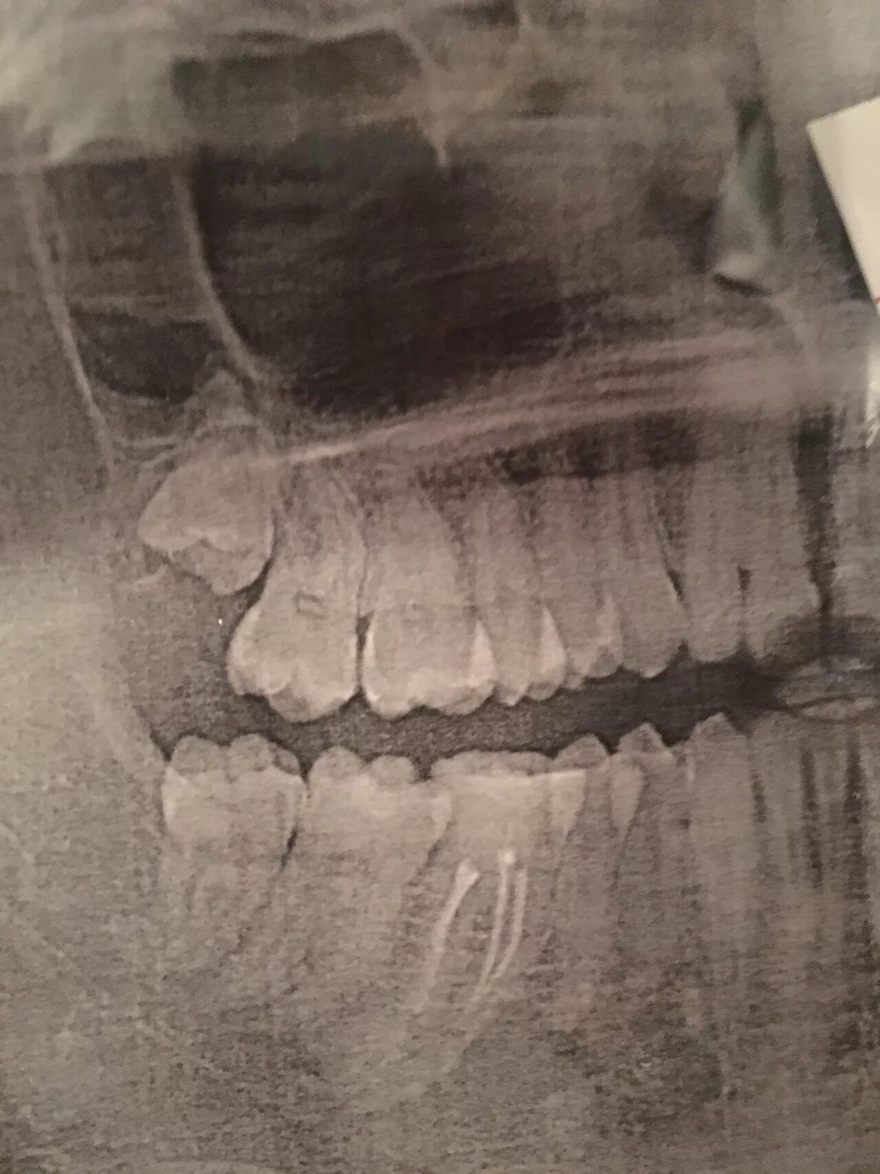 Снимок зубов видное. Рентген зубов верхней челюсти. Ортопантомограмма зубы мудрости. Снимок ровных зубов сбоку рентген. Рентгенограмма верхней челюсти.