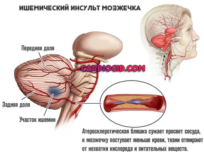 Участок ишемии. Ишемический инсульт мозжечка. Мозжечковое кровоизлияние.