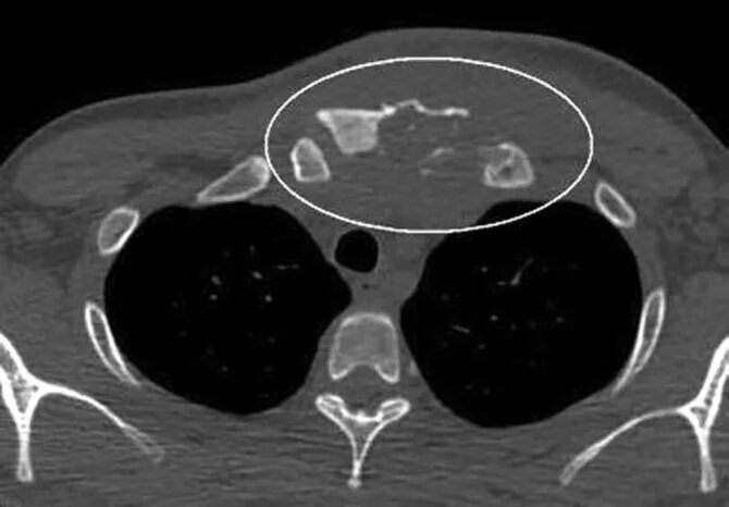 Артрит кт. Асептический некроз грудино-ключичного сочленения кт. Кт артрит грудинно грудино-ключичного сочленения. Артроз ключично-грудинного сочленения кт.