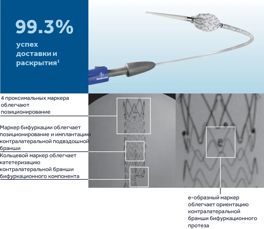 Система доставки стенты. Эндопротезирование стент-графтом). Система доставки стента. Бифуркационный стент-графт. Имплантация стент графта.