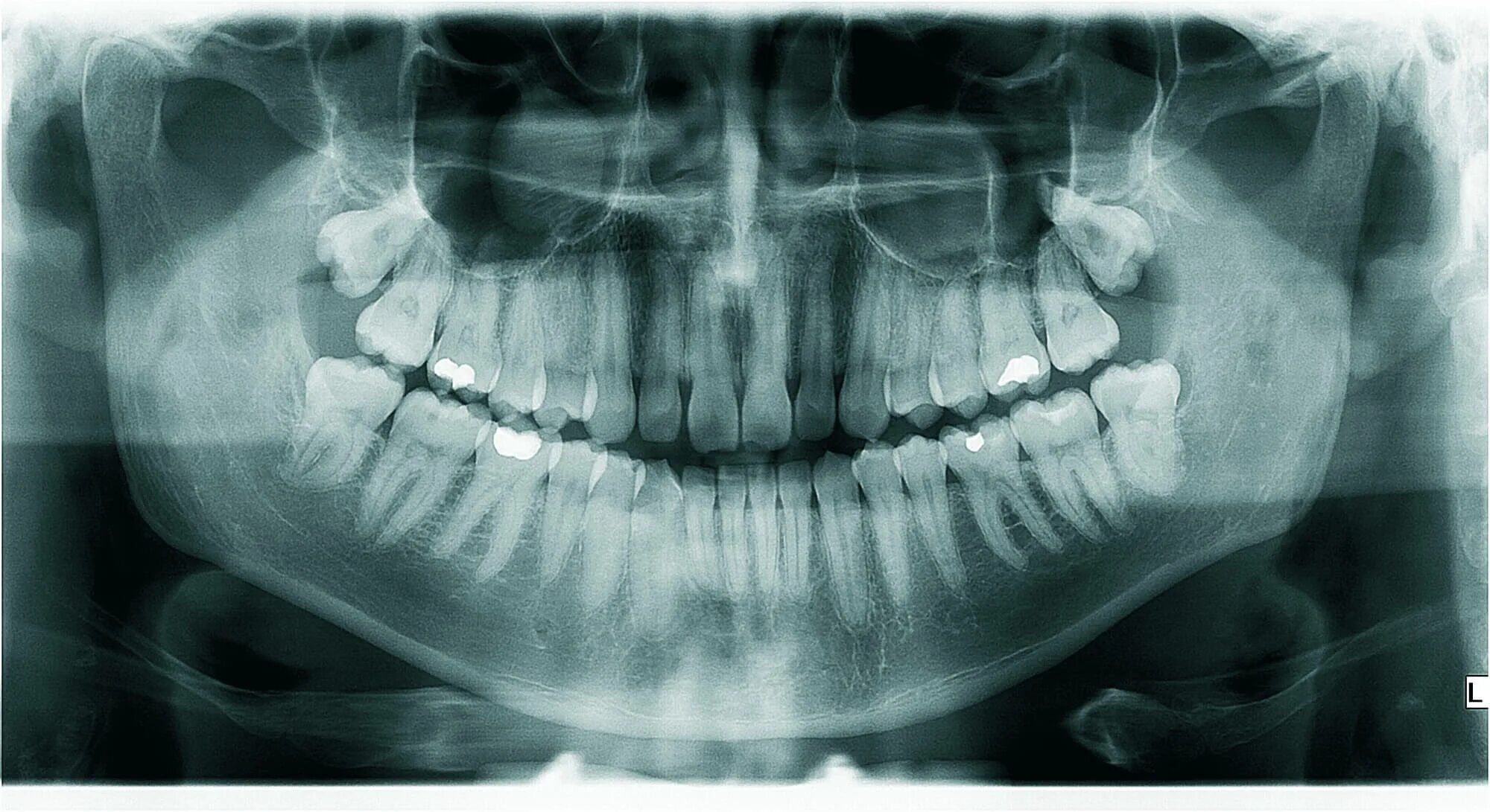 Рентген ортопантомограмма зубов. Перикоронит ортопантомограмма.