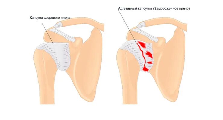 Почему болит сустав плеча. Капсулит плечевого сустава. Адгезивный капсулит плеча. Адгезивный капсулит капсулы плечевого сустава. Боль в плечевом суставе.