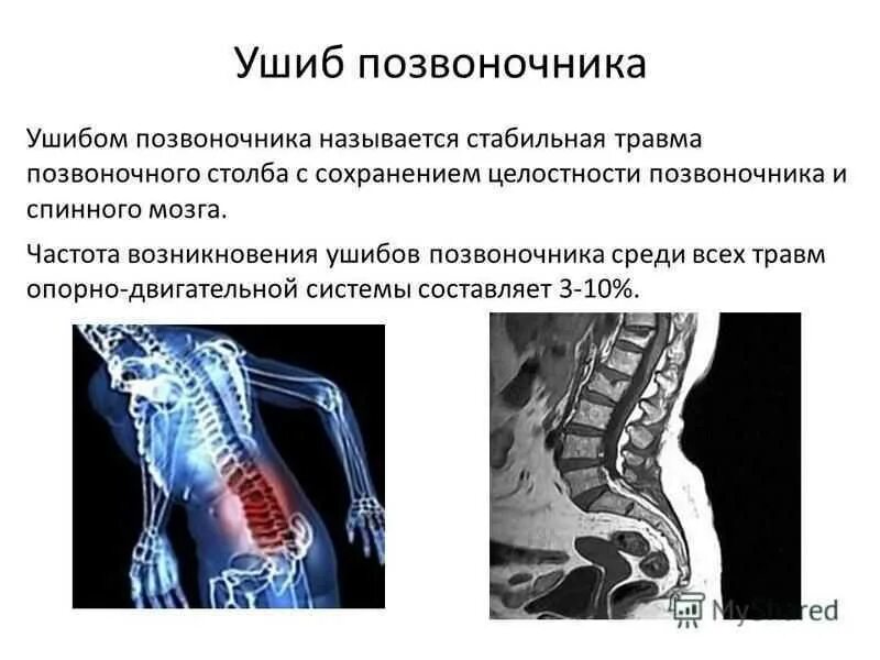 Повреждение поясничного отдела позвоночника симптомы. Поврежденияпозвоночник. Повреждение позвоночника и спинного мозга.